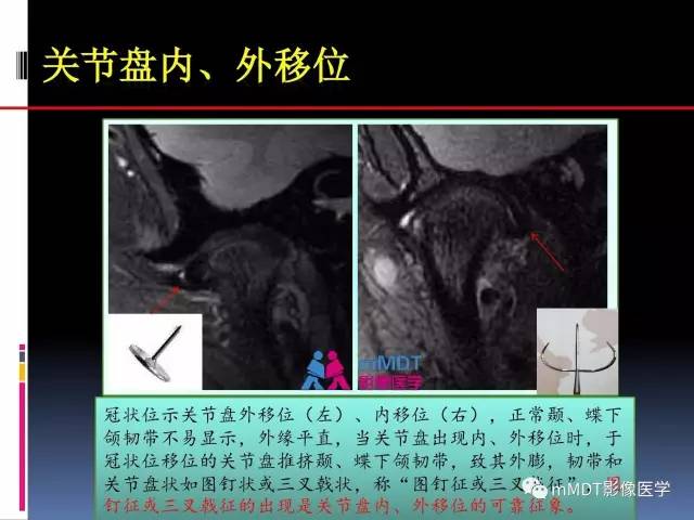 【PPT】颞下颌关节内紊乱的MR诊断