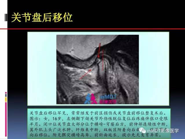 【PPT】颞下颌关节内紊乱的MR诊断