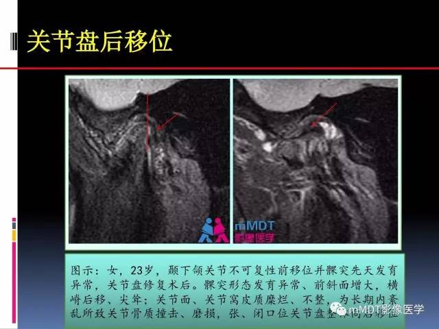 【PPT】颞下颌关节内紊乱的MR诊断