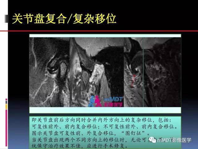 【PPT】颞下颌关节内紊乱的MR诊断