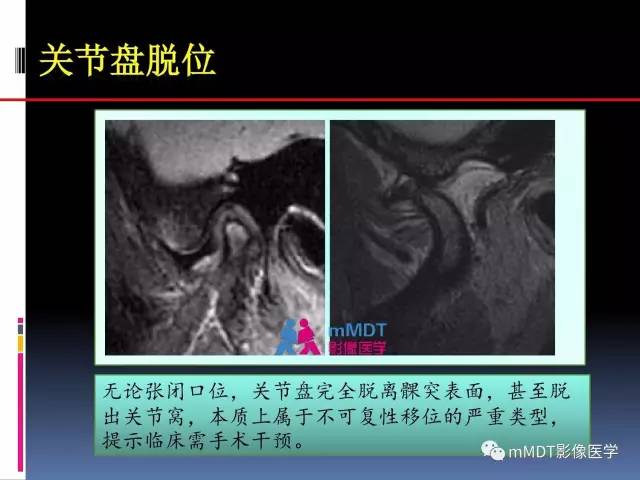 【PPT】颞下颌关节内紊乱的MR诊断