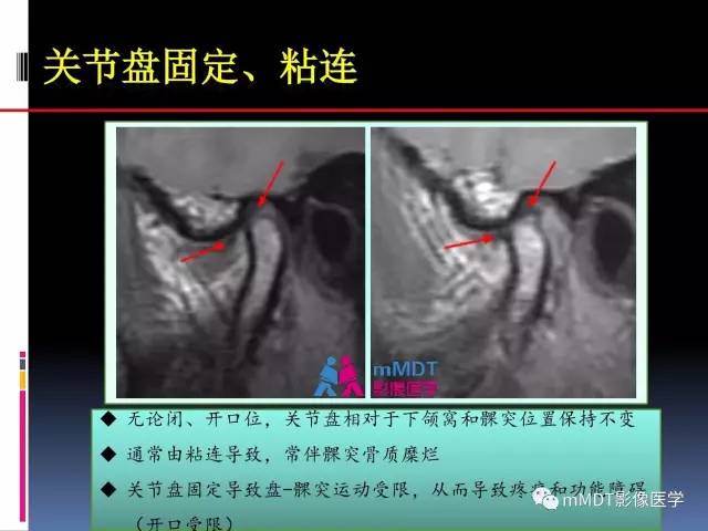 【PPT】颞下颌关节内紊乱的MR诊断
