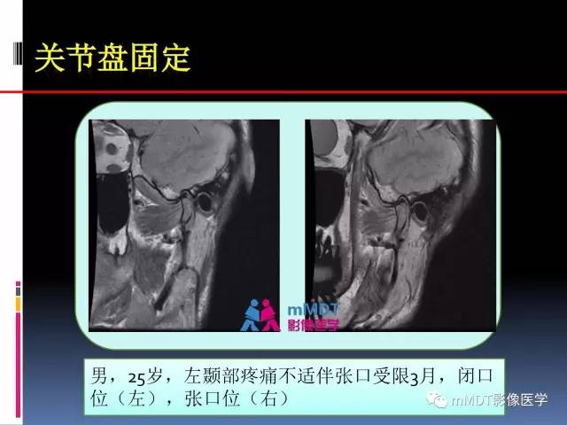 【PPT】颞下颌关节内紊乱的MR诊断