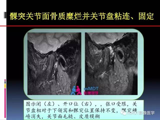 【PPT】颞下颌关节内紊乱的MR诊断
