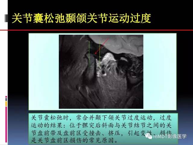 【PPT】颞下颌关节内紊乱的MR诊断