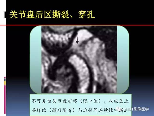 【PPT】颞下颌关节内紊乱的MR诊断