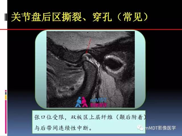 【PPT】颞下颌关节内紊乱的MR诊断