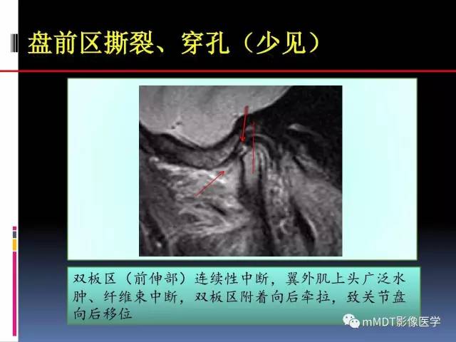 【PPT】颞下颌关节内紊乱的MR诊断