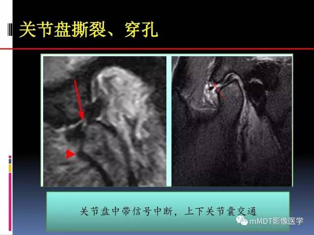 【PPT】颞下颌关节内紊乱的MR诊断
