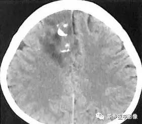 少突胶质细胞瘤诊断要点 少突胶质细胞瘤诊断要点