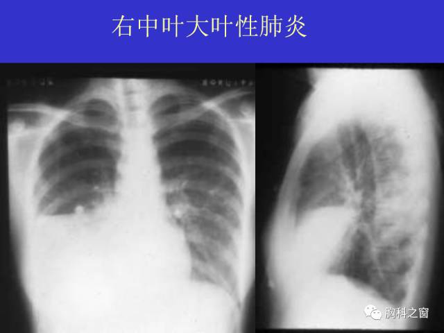 【PPT】肺部感染性疾病的CT