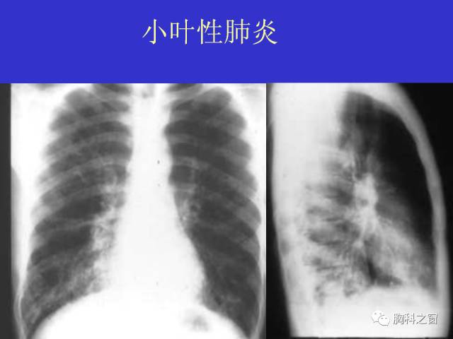 【PPT】肺部感染性疾病的CT