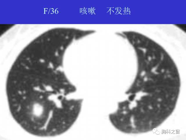 【PPT】肺部感染性疾病的CT