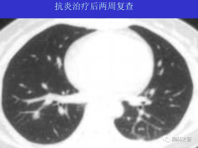 【PPT】肺部感染性疾病的CT