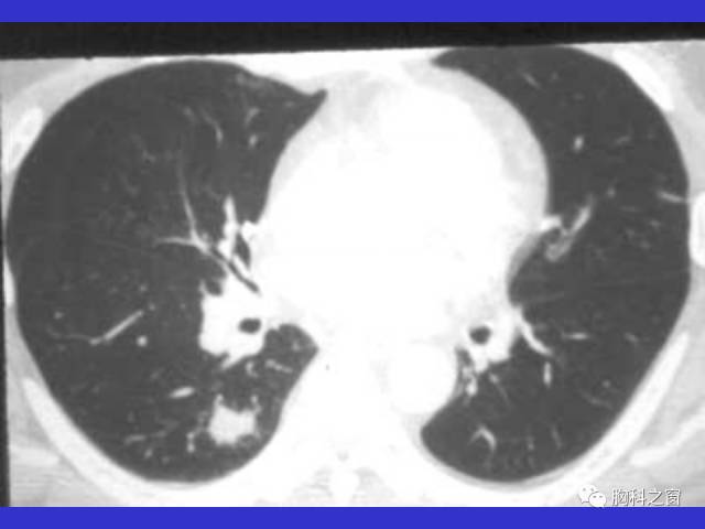 【PPT】肺部感染性疾病的CT