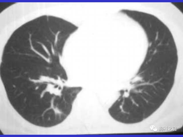 【PPT】肺部感染性疾病的CT