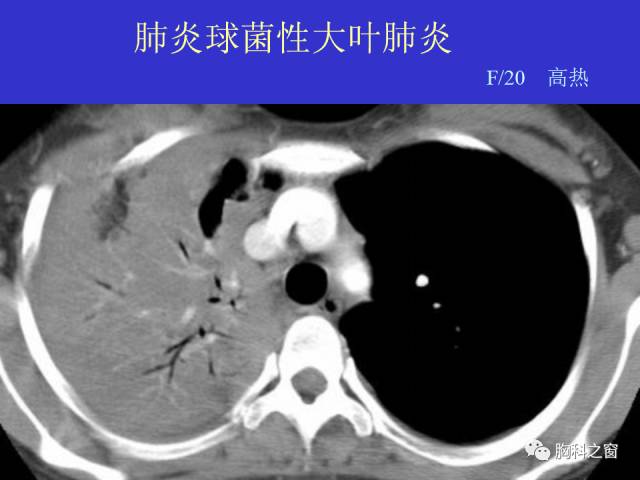 【PPT】肺部感染性疾病的CT