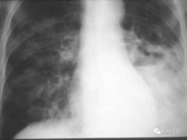 【PPT】肺部感染性疾病的CT