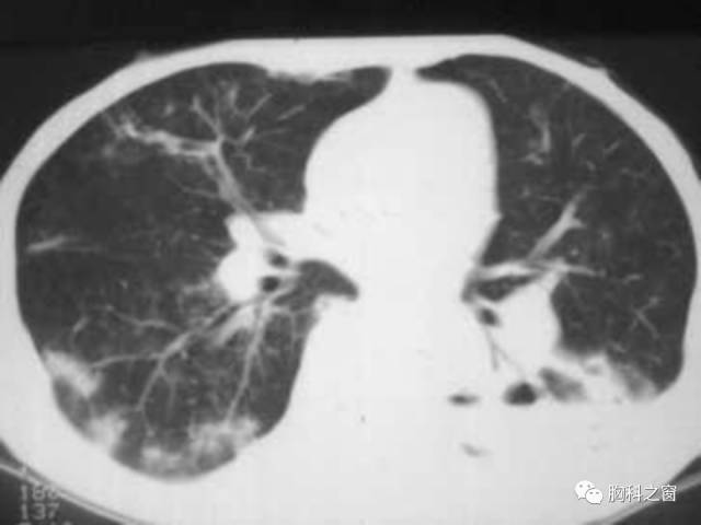 【PPT】肺部感染性疾病的CT