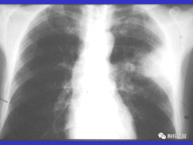 【PPT】肺部感染性疾病的CT