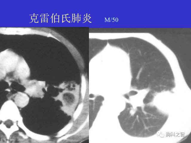 【PPT】肺部感染性疾病的CT