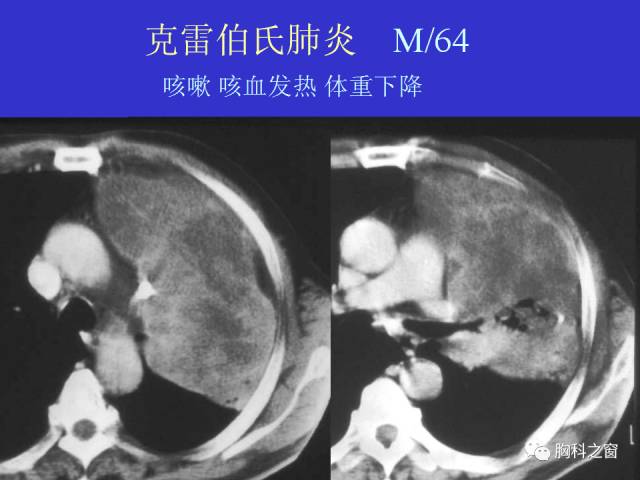 【PPT】肺部感染性疾病的CT