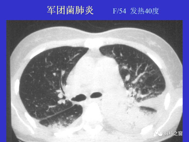 【PPT】肺部感染性疾病的CT