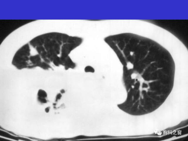 【PPT】肺部感染性疾病的CT