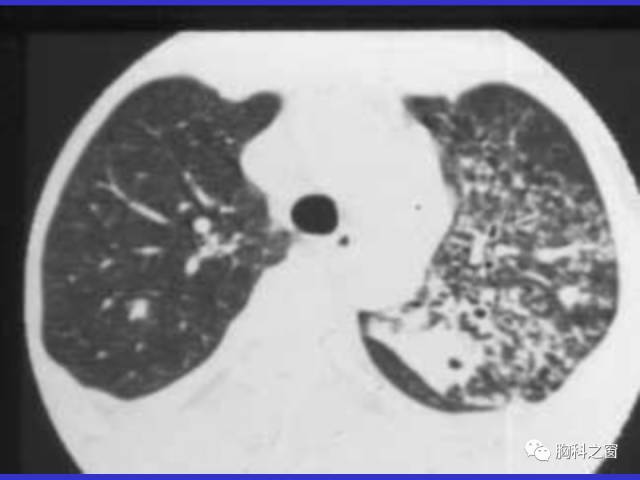 【PPT】肺部感染性疾病的CT