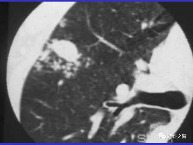 【PPT】肺部感染性疾病的CT