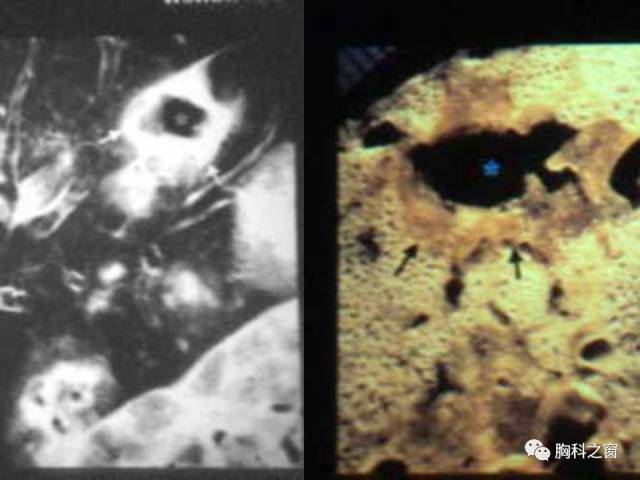 【PPT】肺部感染性疾病的CT
