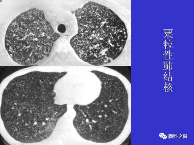 【PPT】肺部感染性疾病的CT