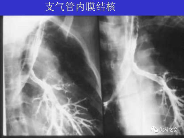 【PPT】肺部感染性疾病的CT