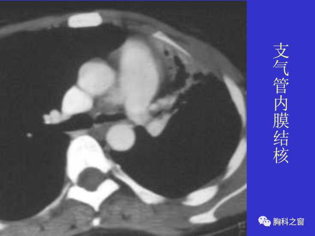 【PPT】肺部感染性疾病的CT