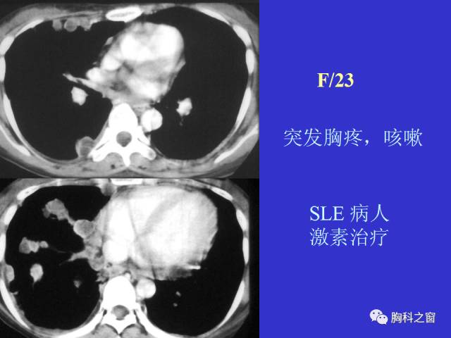 【PPT】肺部感染性疾病的CT