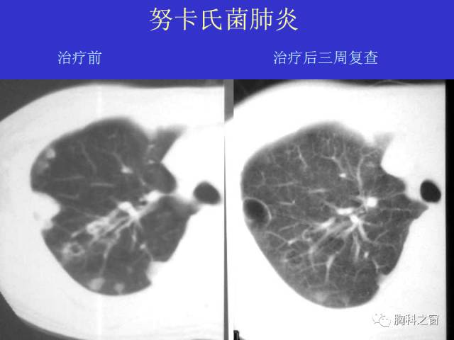 【PPT】肺部感染性疾病的CT