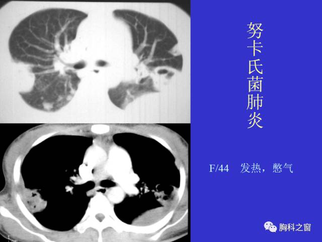 【PPT】肺部感染性疾病的CT