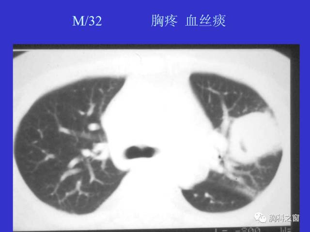 【PPT】肺部感染性疾病的CT