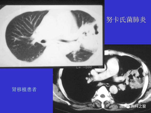 【PPT】肺部感染性疾病的CT