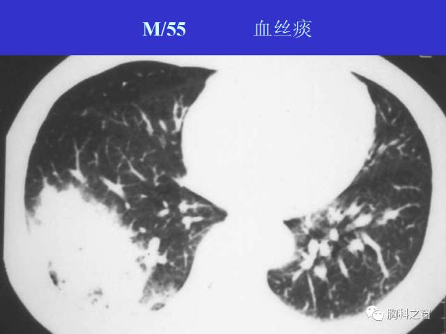 【PPT】肺部感染性疾病的CT