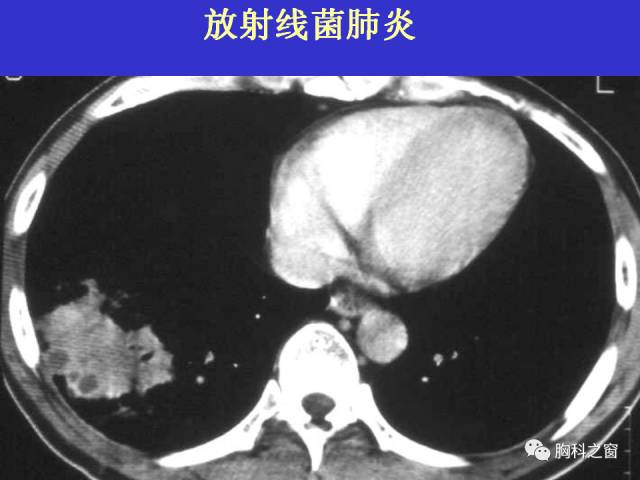 【PPT】肺部感染性疾病的CT