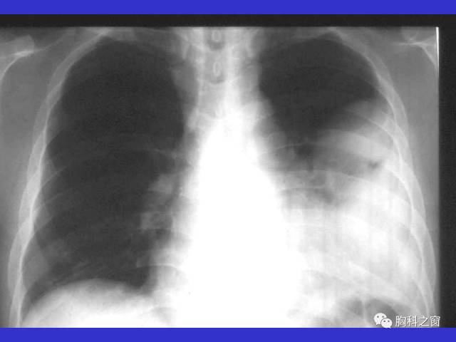 【PPT】肺部感染性疾病的CT