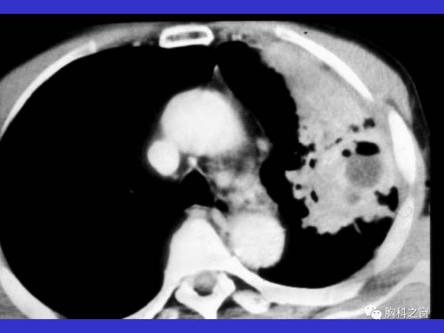 【PPT】肺部感染性疾病的CT
