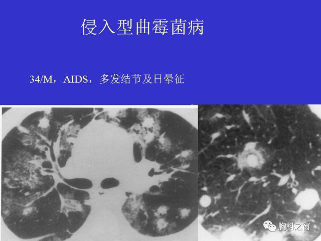 【PPT】肺部感染性疾病的CT