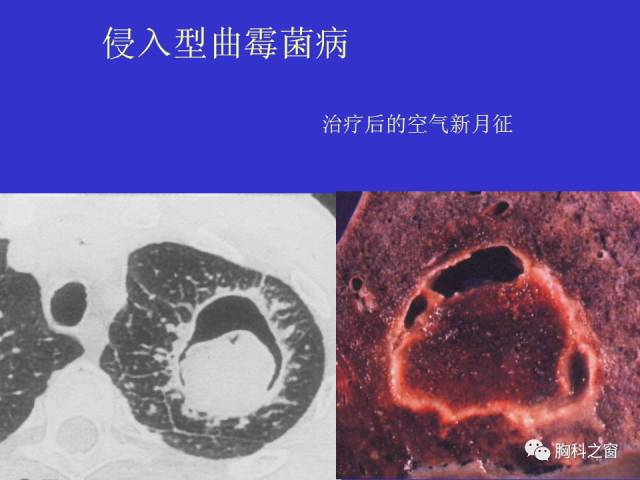 【PPT】肺部感染性疾病的CT
