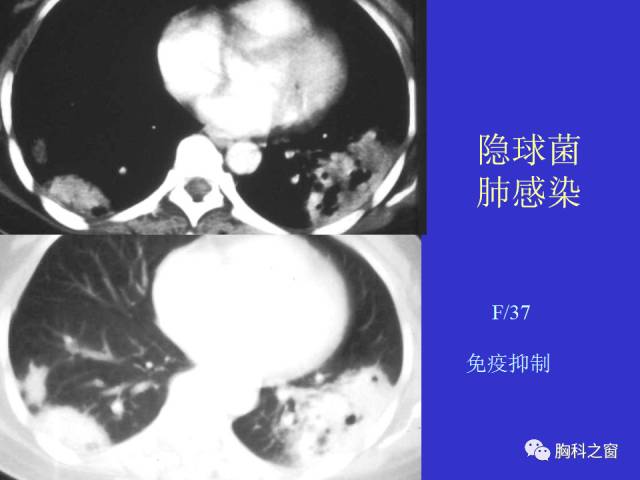 【PPT】肺部感染性疾病的CT