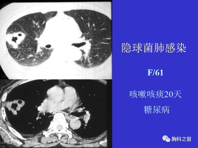 【PPT】肺部感染性疾病的CT