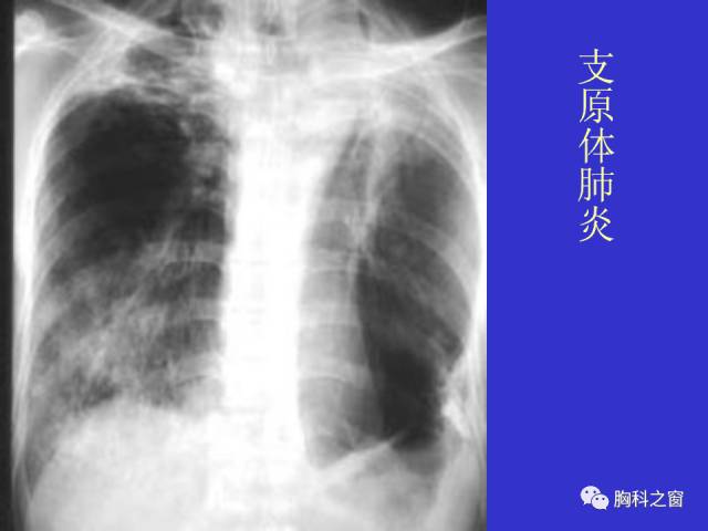 【PPT】肺部感染性疾病的CT