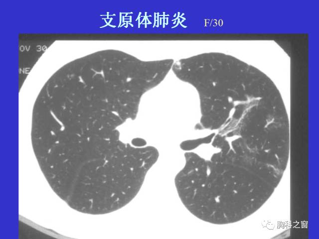 【PPT】肺部感染性疾病的CT