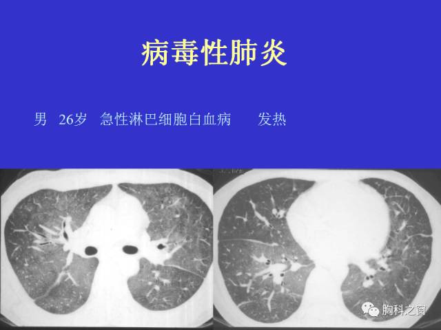 【PPT】肺部感染性疾病的CT